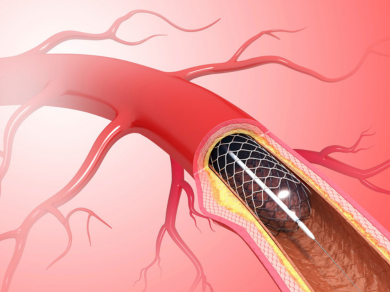 Intravascular Stents Market